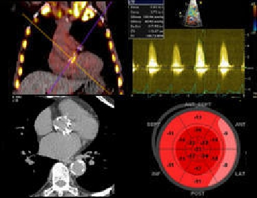 Aortic Stenosis image