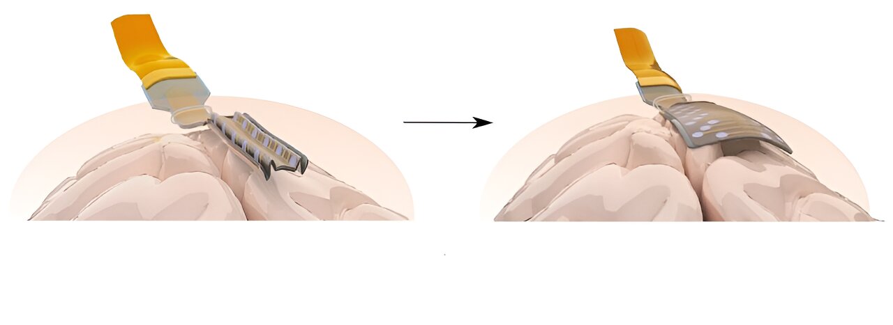 1_Origami-inspired folding electrodes could reduce surgery needed to treat brain.jpg