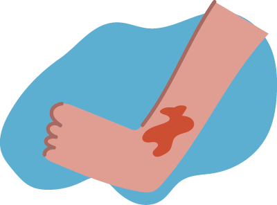 Leg and foot with a red mark showing an injury