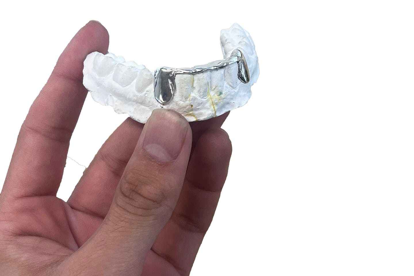 A plaster cast made using Acuña’s teeth.