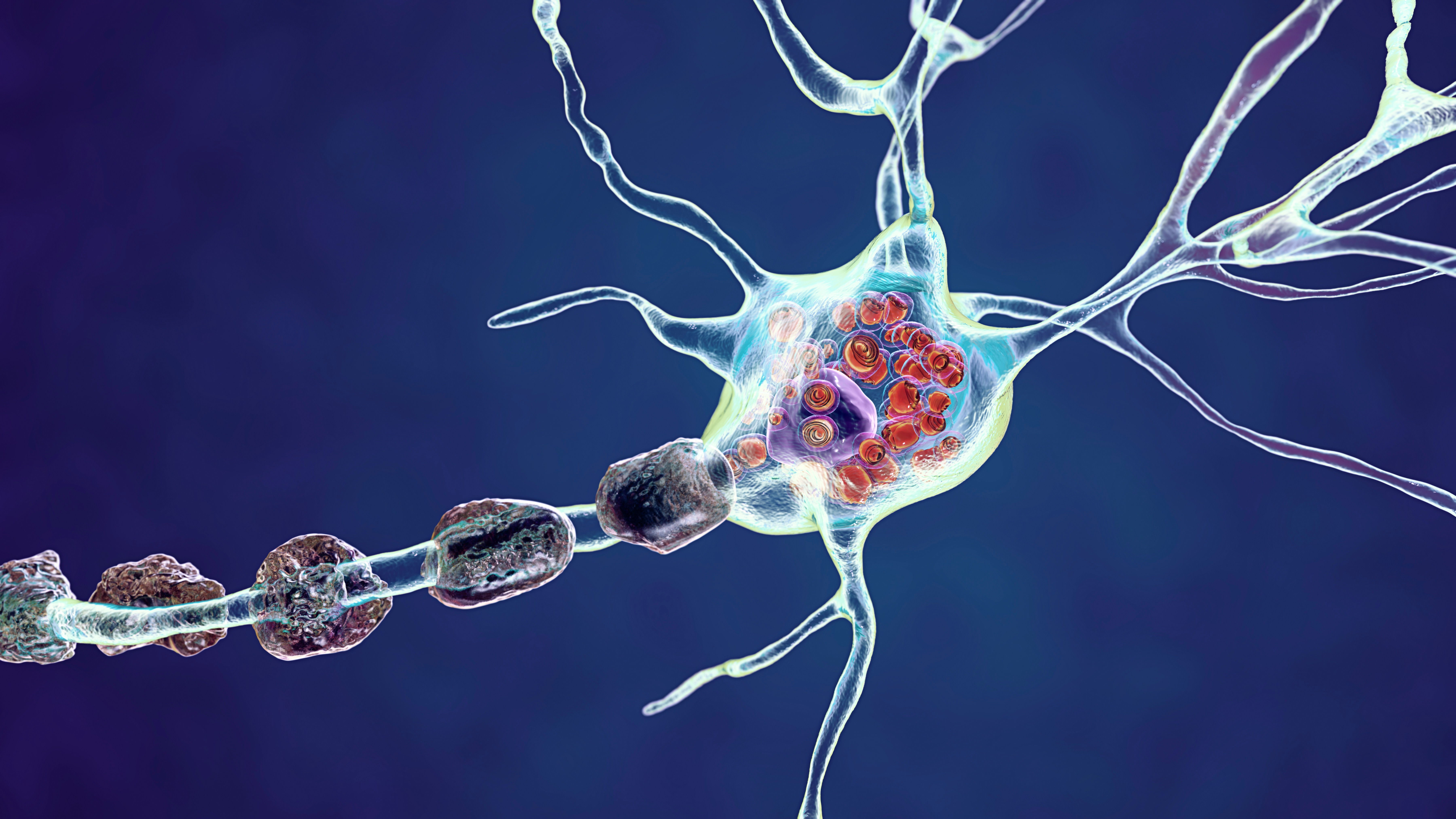 Illustration of brain neuron in lysosomal storage disease with branching dendrites and a myelinated axon.