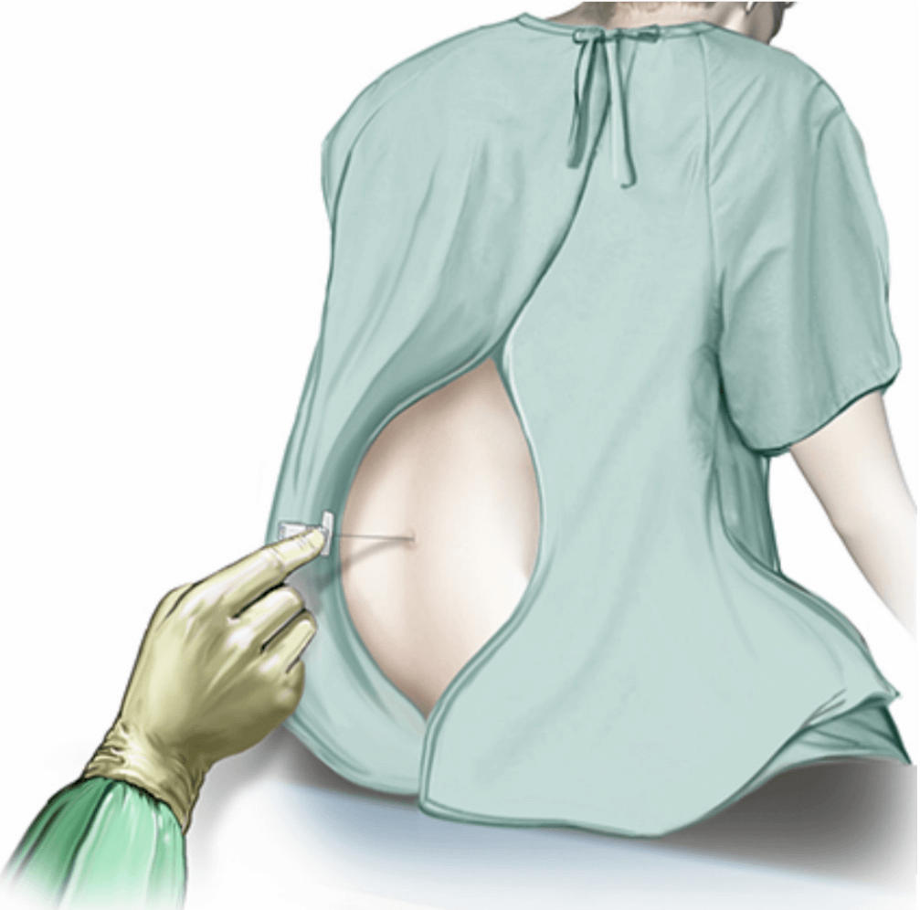 Illustration of a spinal being given.