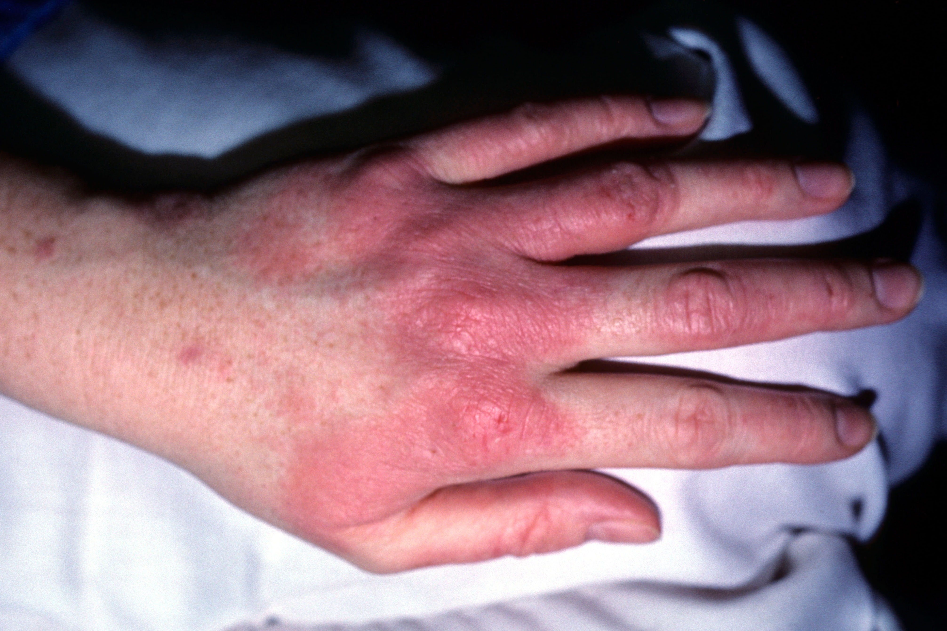 Photo of eczema on the back of the hand and fingers.