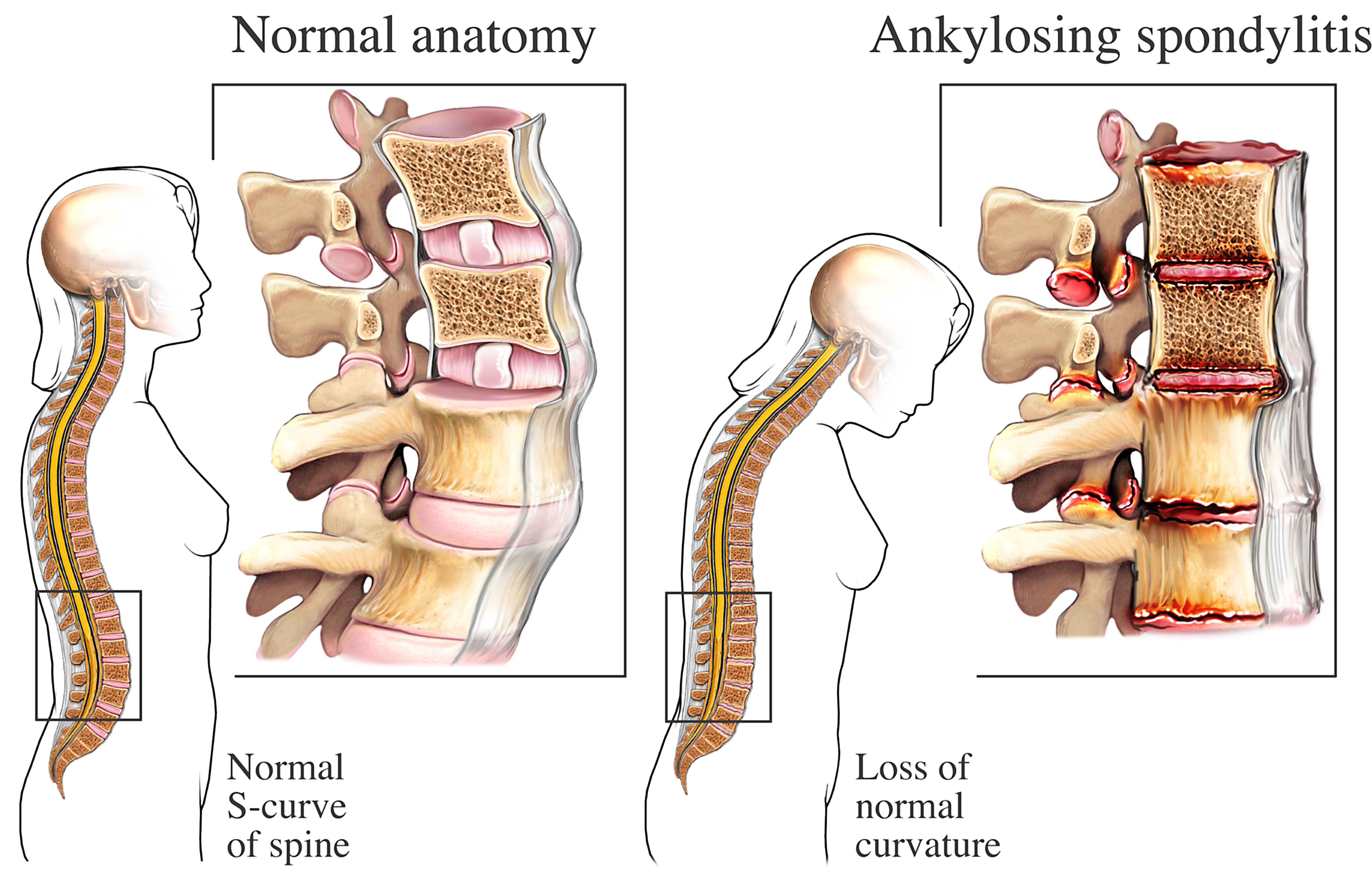 Illustration showing the difference between an anatomy of a normal spine, in comparison to one with ankylosing spondylitis.