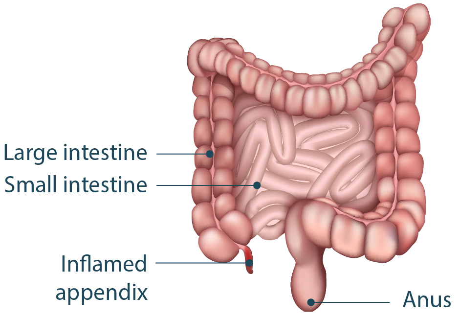 Illustration showing the inflamed appendix.