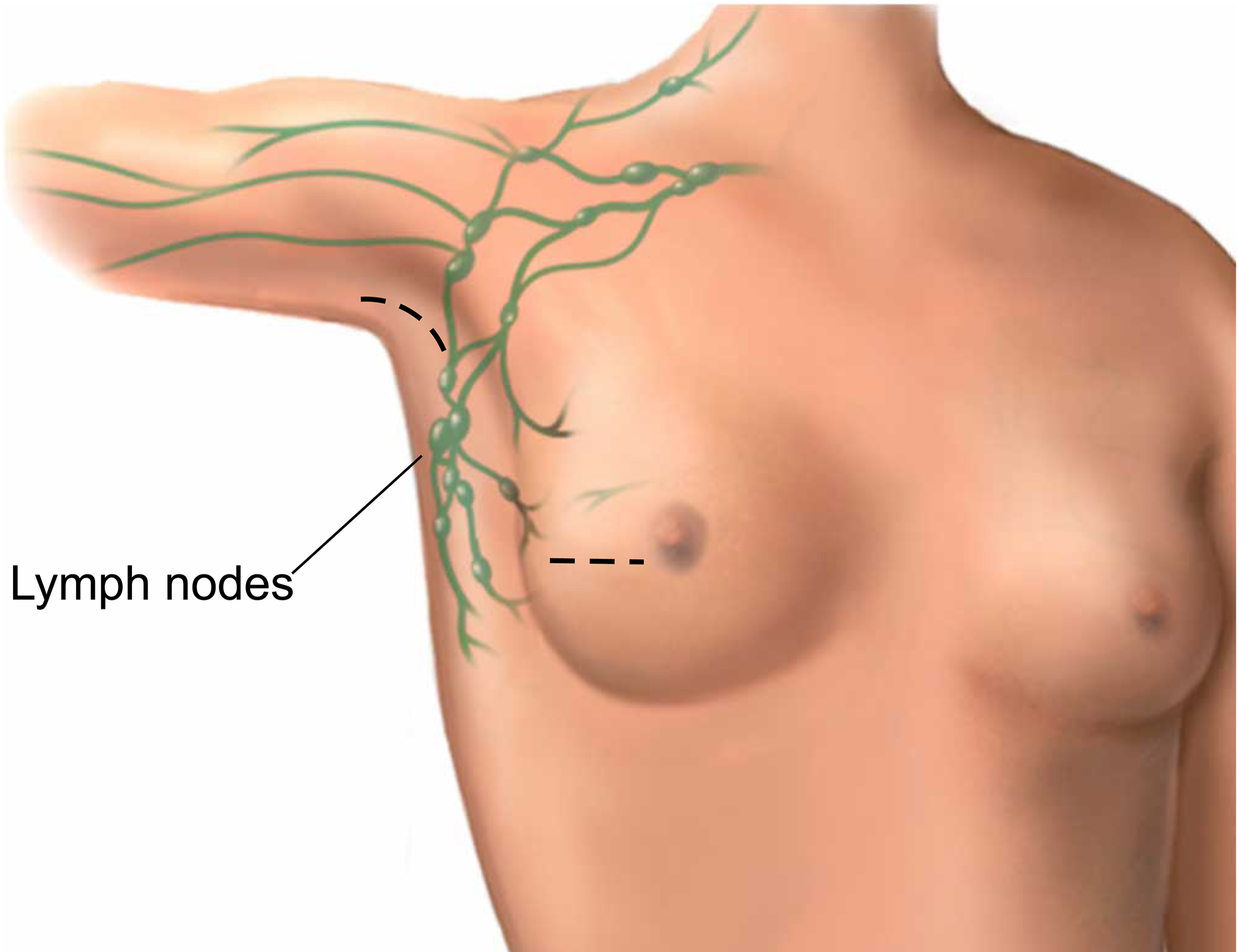 Illustration showing where they will cut for a wide local excision and axillary surgery.