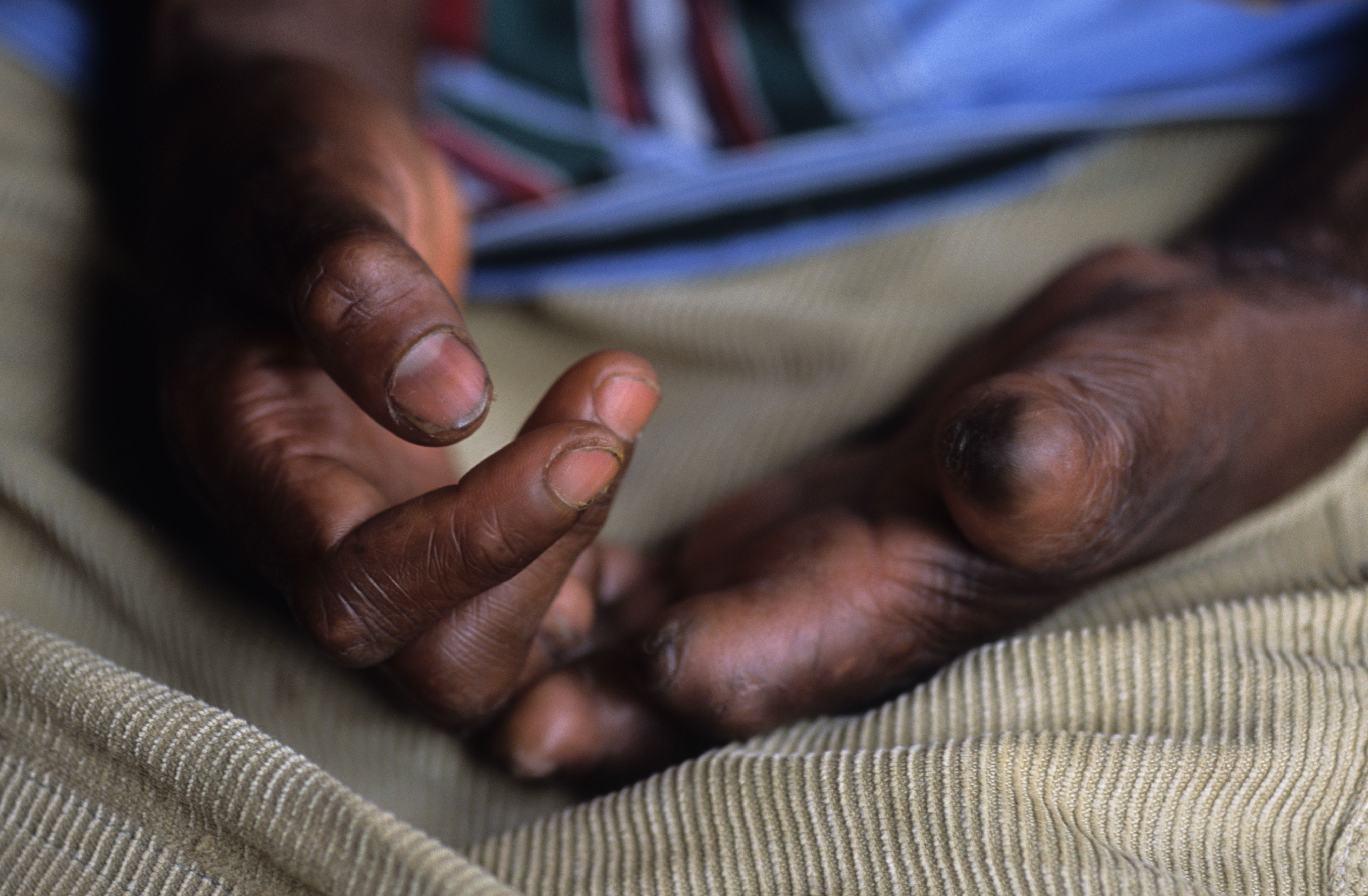 Photo of deformed hands caused by leprosy.
