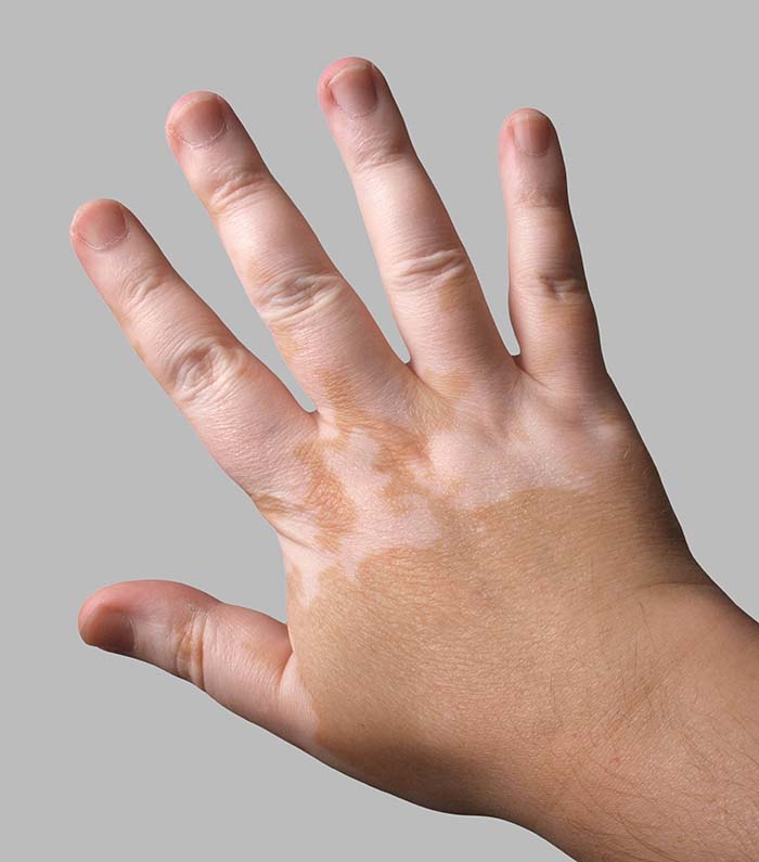Image of vitiligo on a persons hand, the skin has patches that have become pale/white.