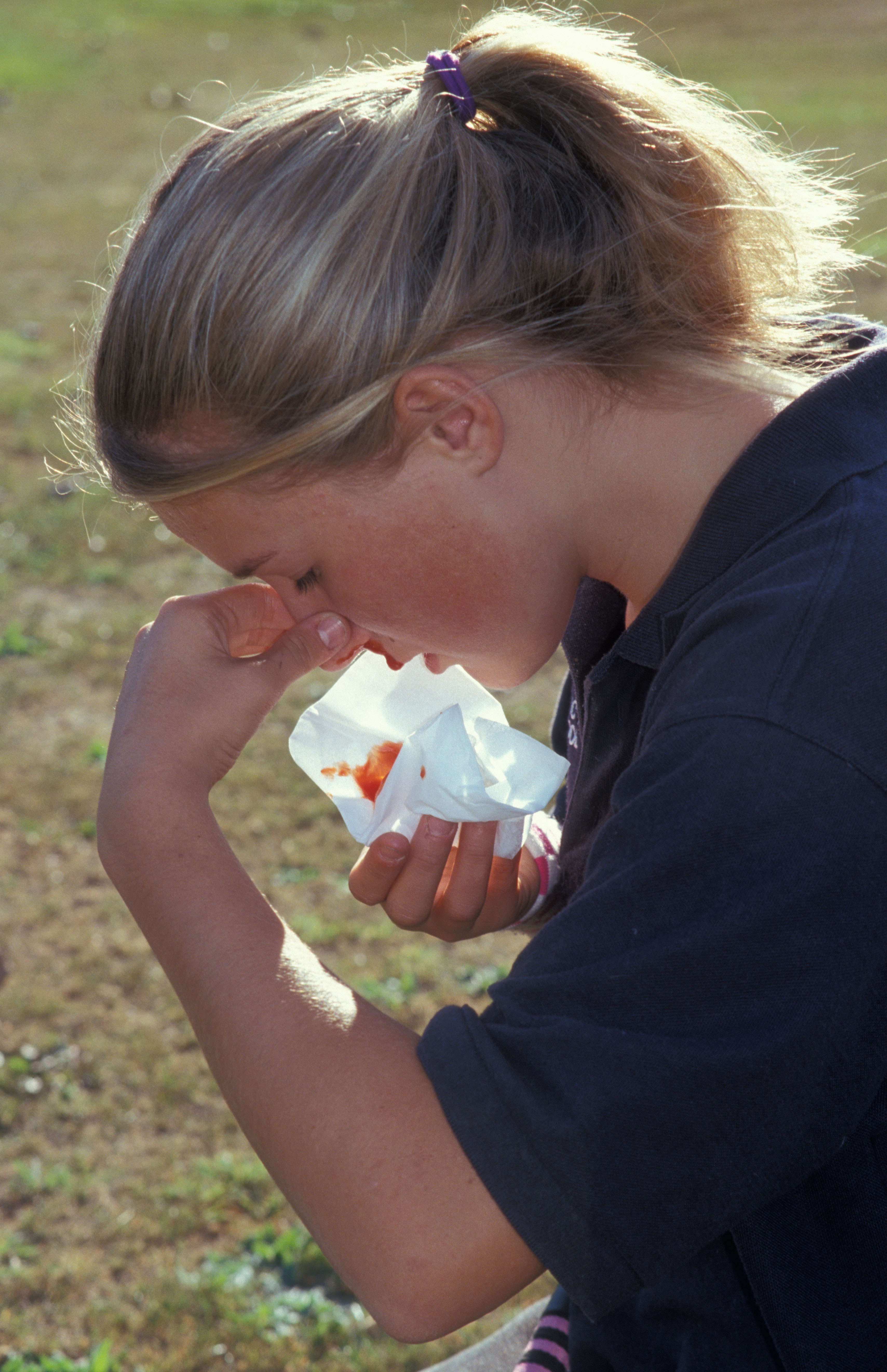 Girl with a nosebleed.