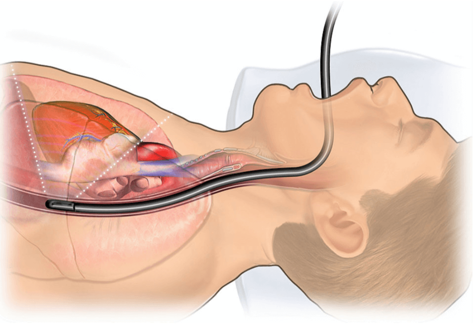 Illustration of a trans-oesophageal echocardiogram.