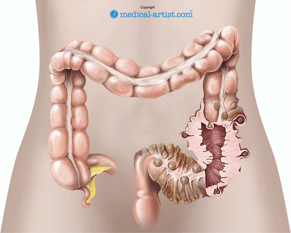 The pouches on the large bowel that indicate Diverticular
disease.