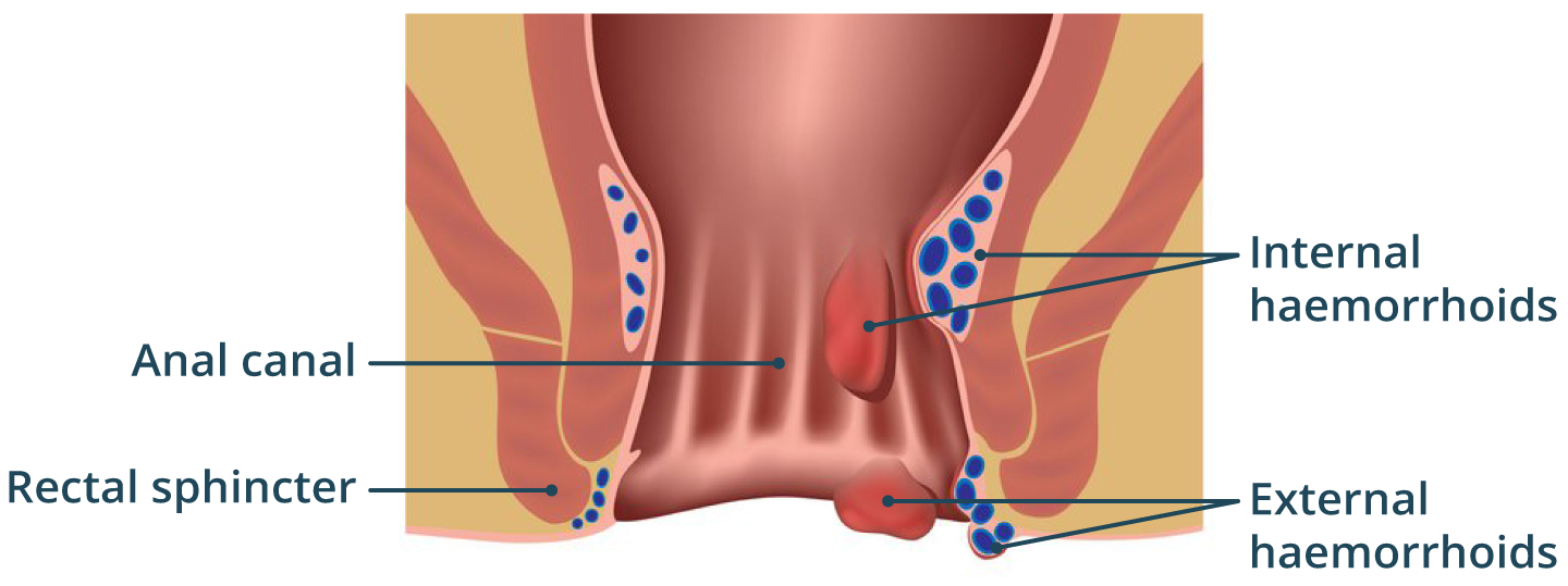 Illustration showing haemorrhoids internally and externally.