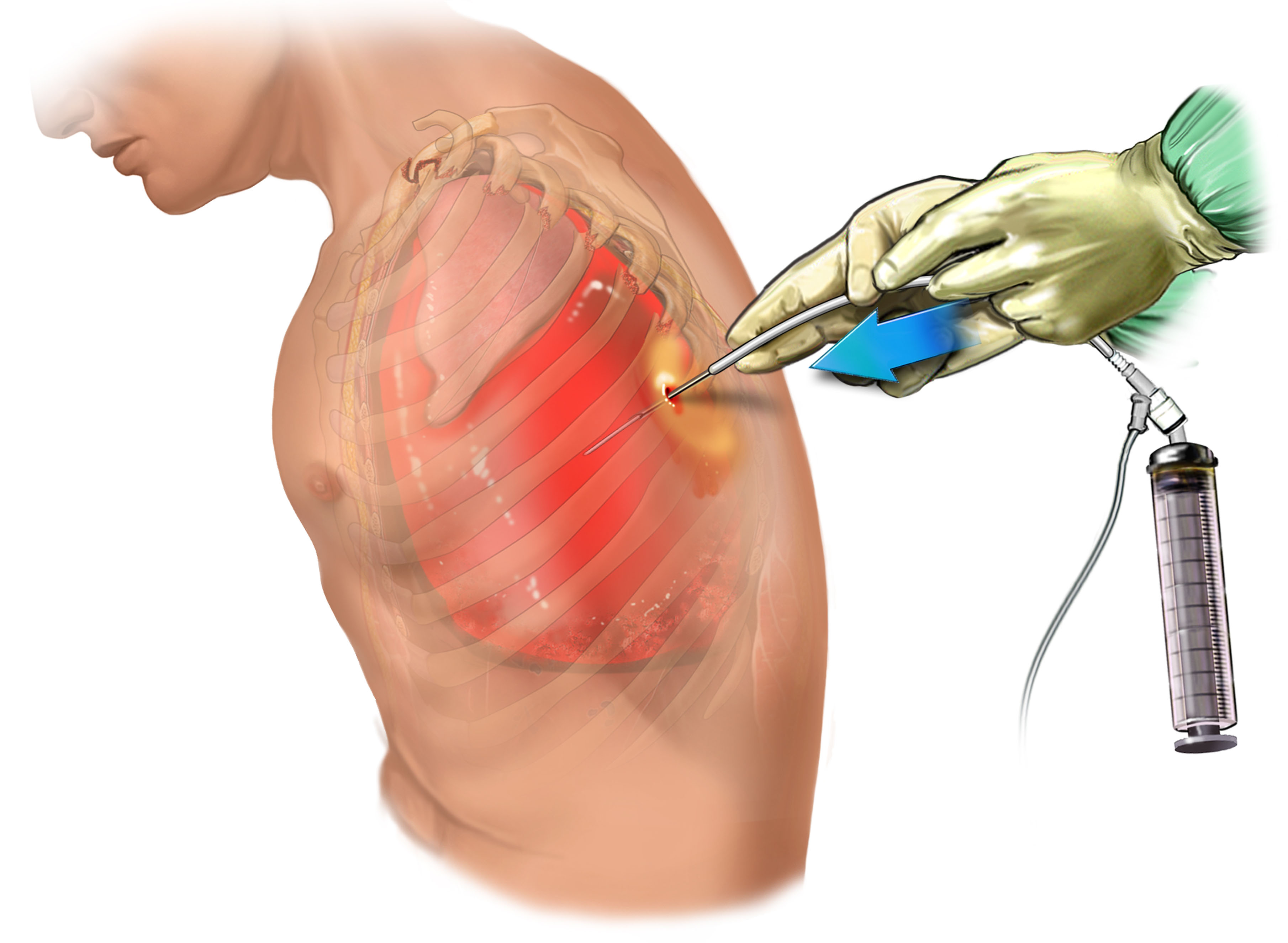Illustration catheter aspiration in practice for pneumothorax’.
