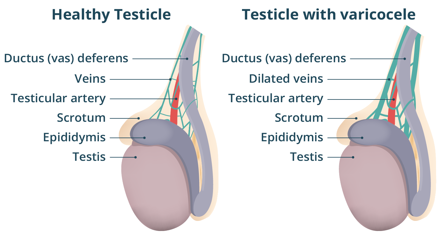 Illustration of a healthy scrotum, and a scrotum with varicocele, where the veins have swollen.