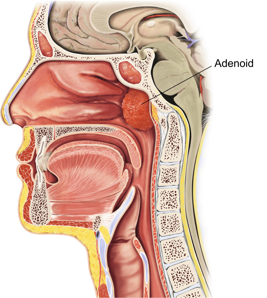 Illustration showing how an enlarged adenoid can obstruct breathing.