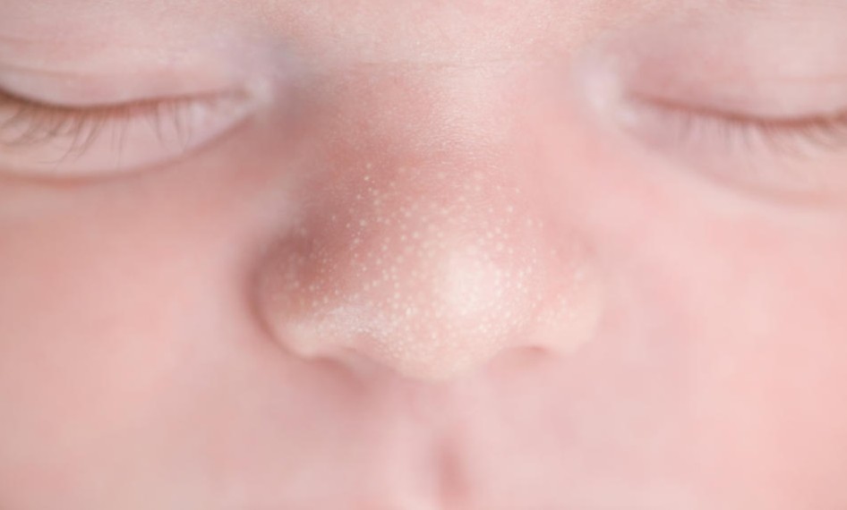 Image of Milia present on a babies nose