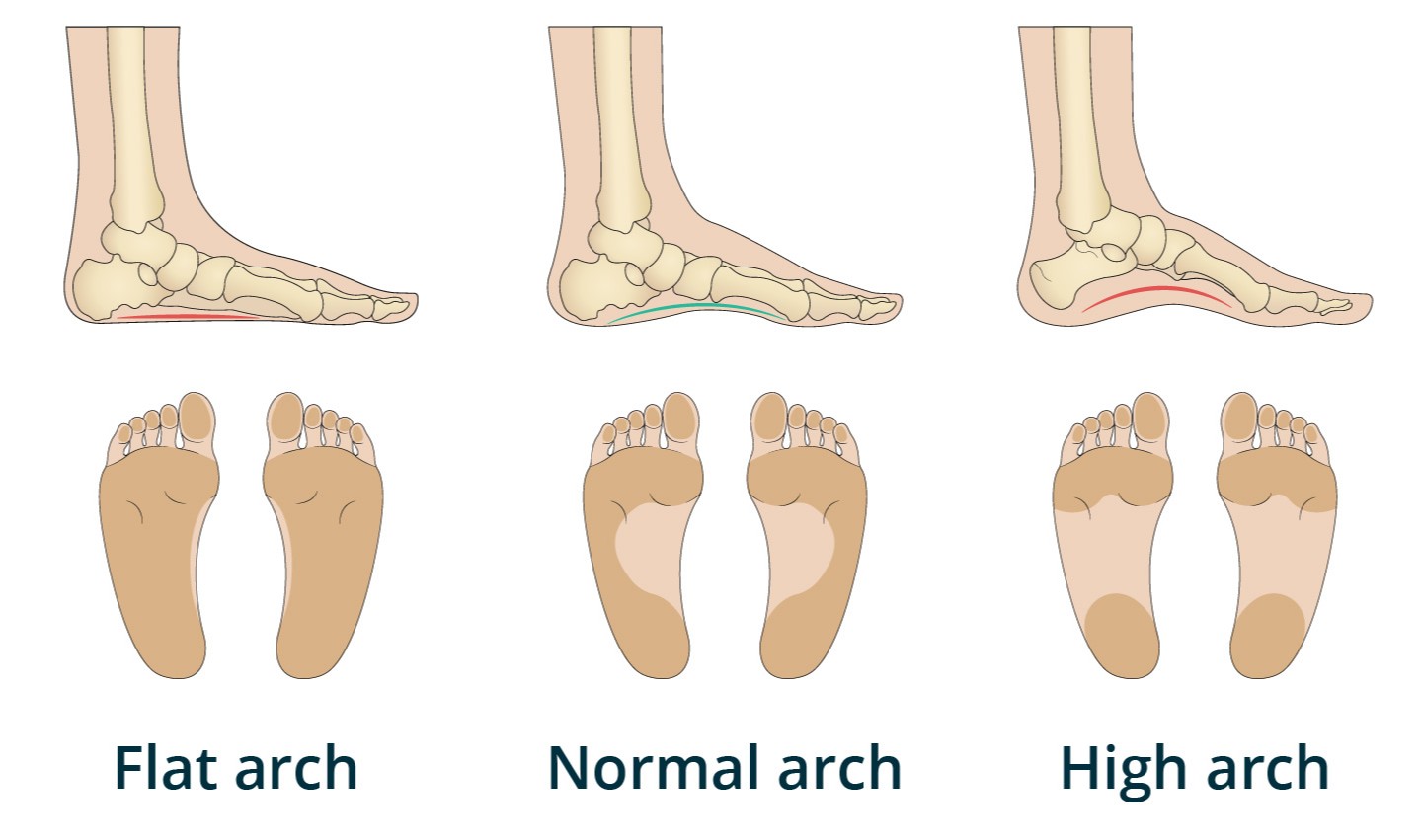 A diagram showing the difference between Normal, flat and high arches in feet.