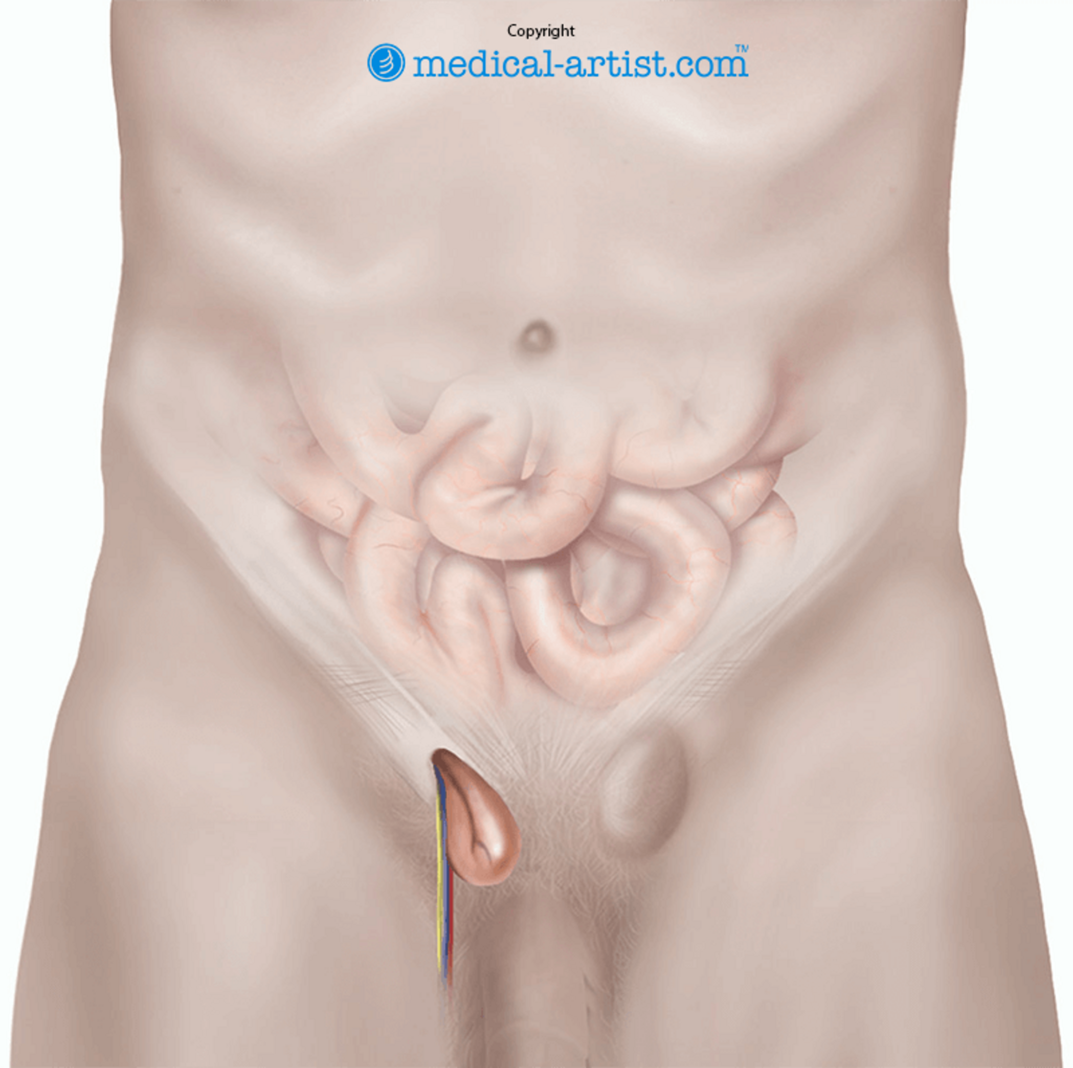 Illustration of an inguinal hernia.