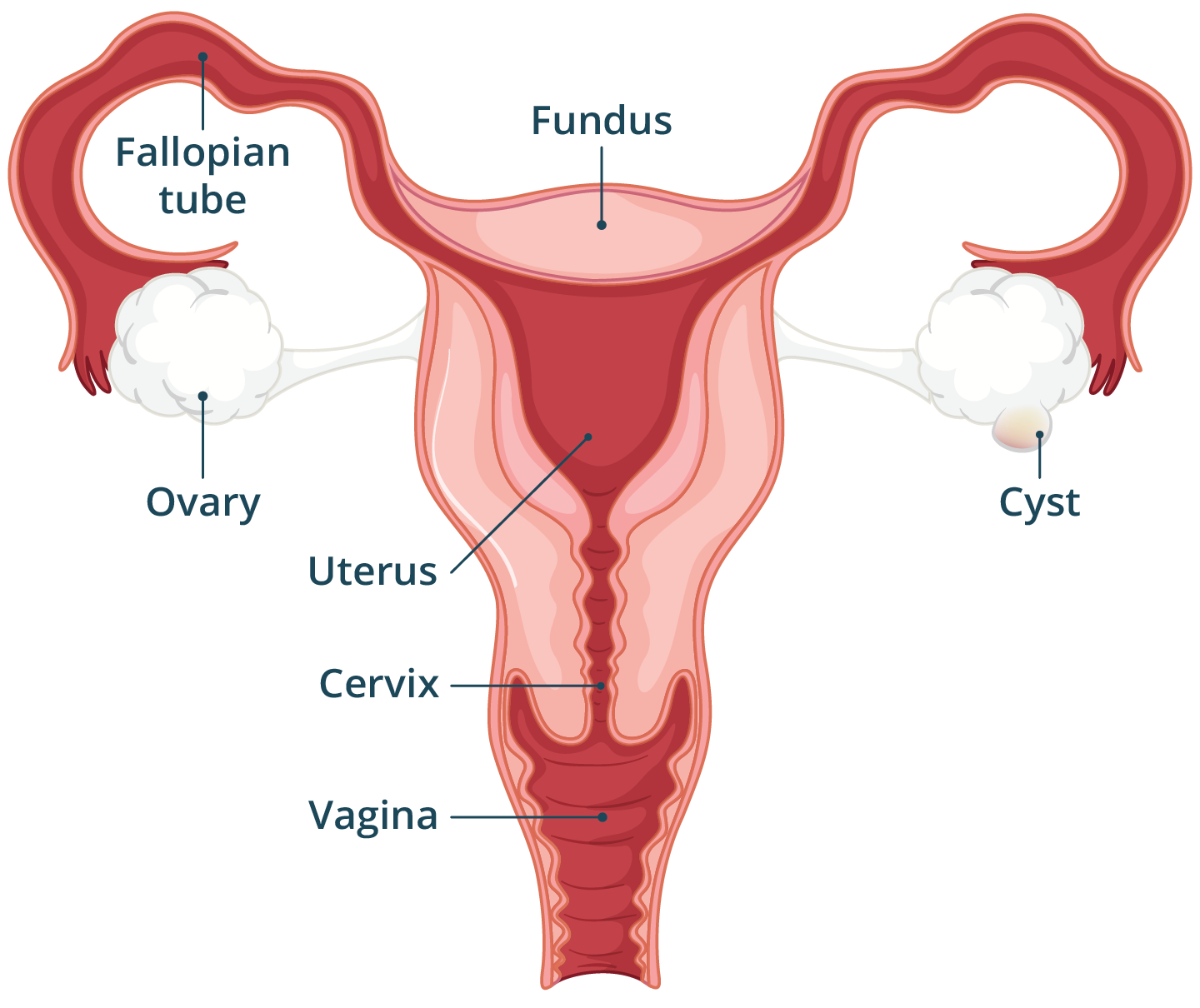 Illustration of the female reproductive system with an ovarian cyst.
