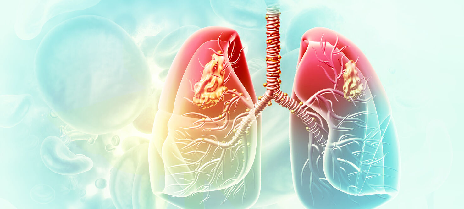 Medical Illustration showing lung cancer or bronchial carcinoma. 3d illustration