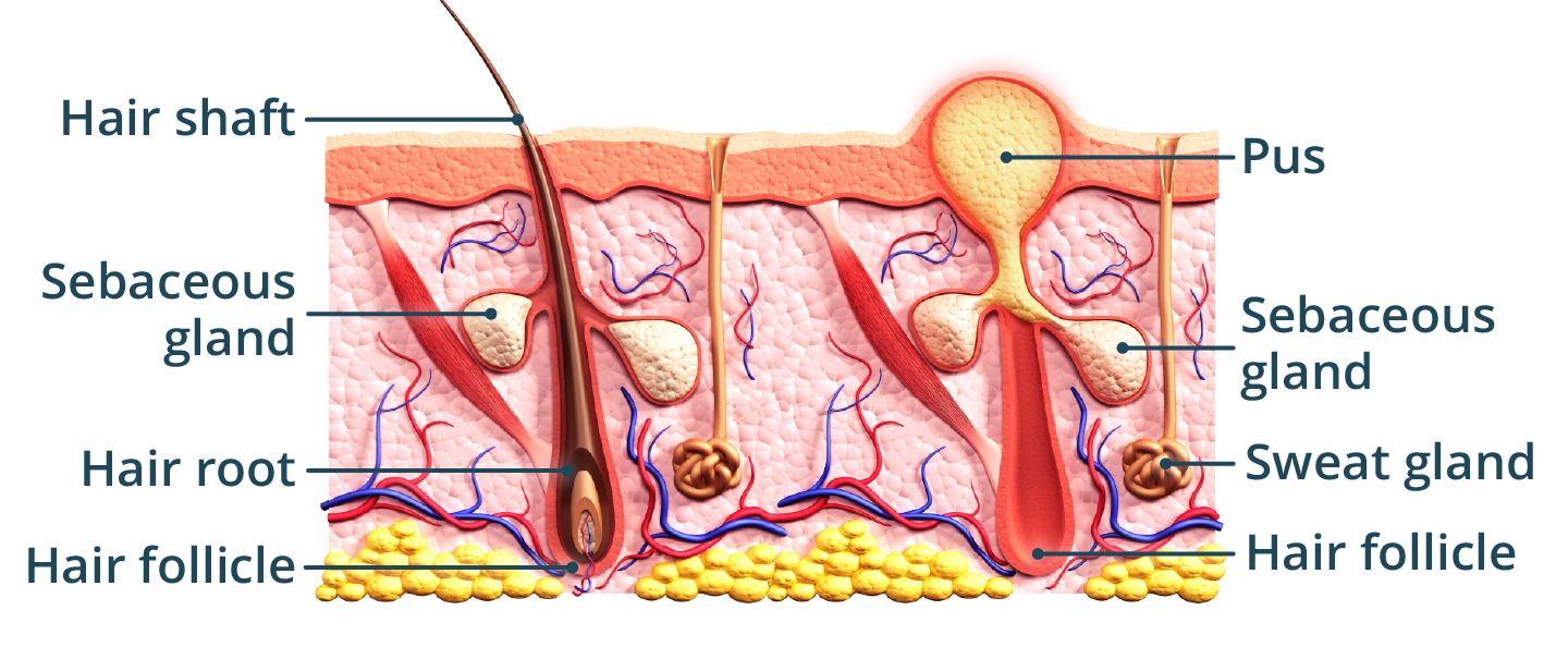 An illustration showing a healthy hair follicle on the left, compared to one infected on the right. Leading to a pus filled lump.