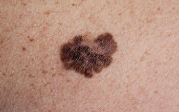 Melanoma