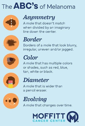 A graphic illustrating the ABCDEs of Melanoma detection