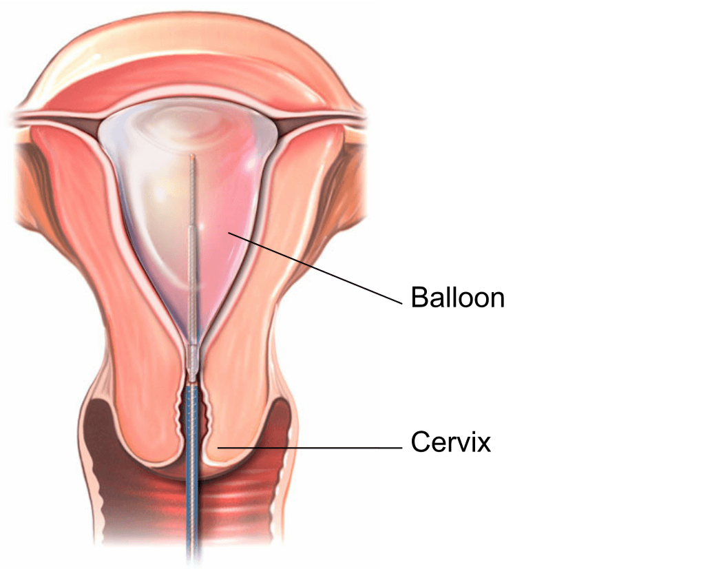 Illustration of a thermal balloon inflated inside the uterus (womb).