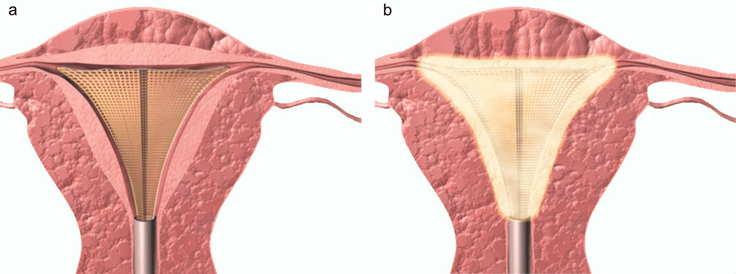 Illustration showing the uterus with the mesh expanded inside next to a uterus with radio-frequency energy through the mesh.