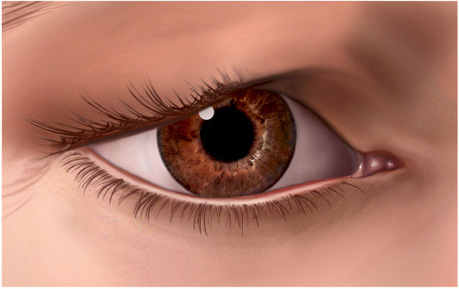 Illustration showing an eyelid with excess skin