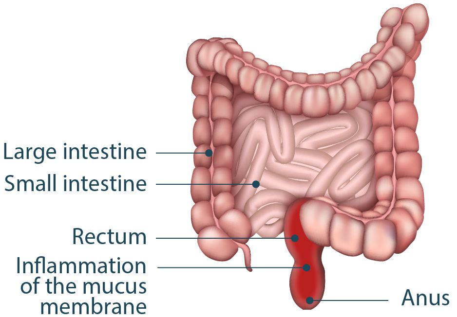 A diagram showing the rectum and anus. Proctitis is an inflammation of the rectum.