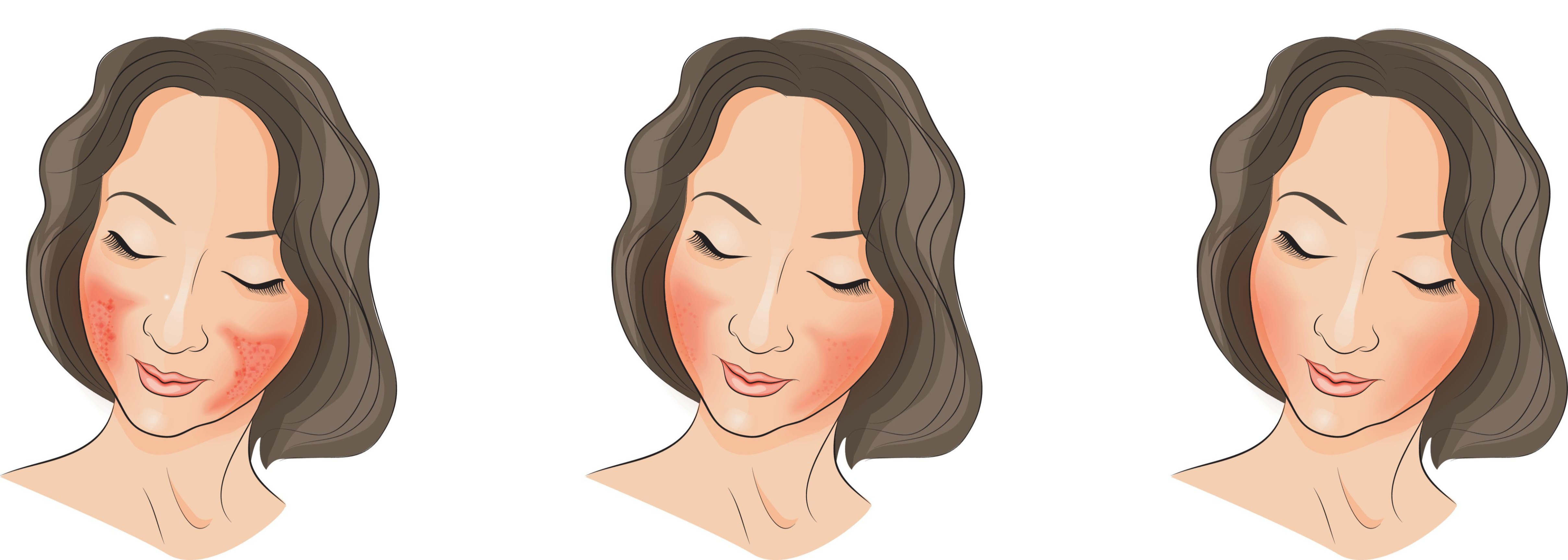 Illustration showing different stages of rosacea.