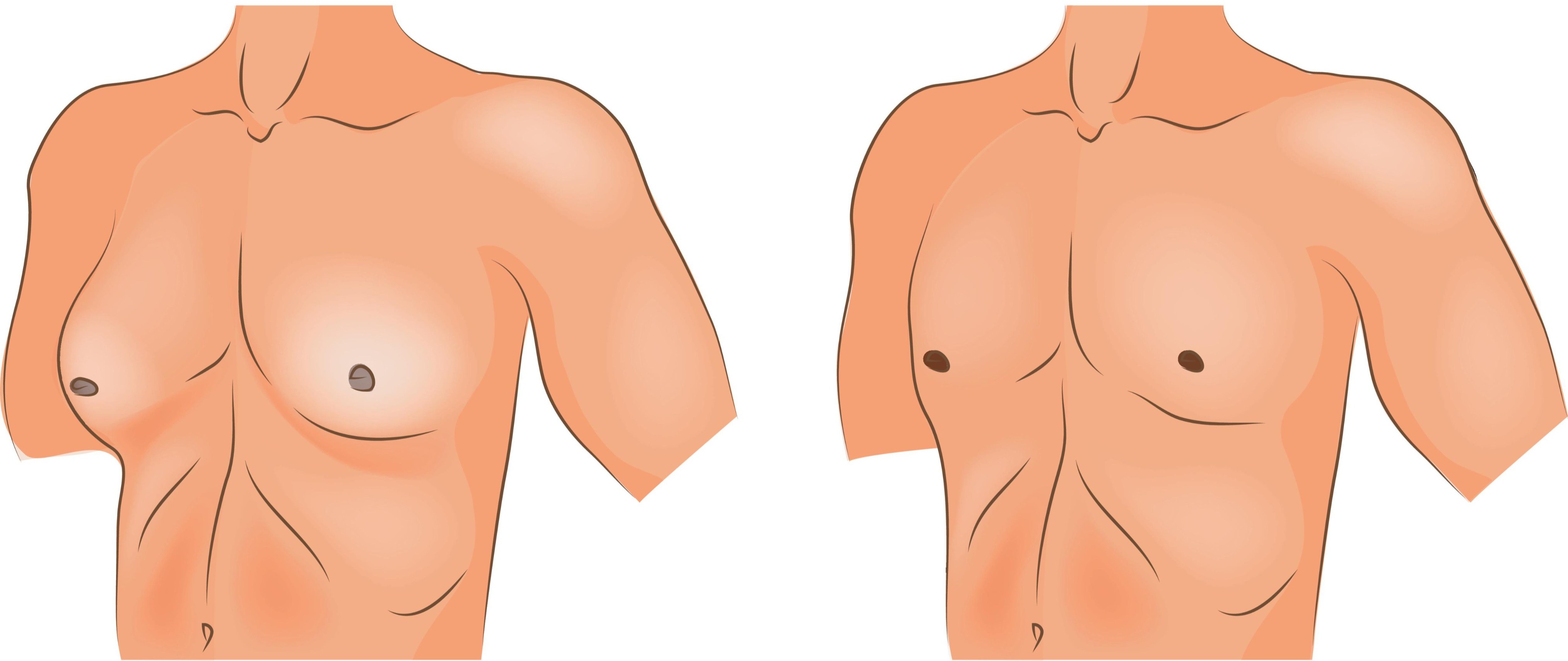 Illustration showing the difference between gynaecomastia (left) and a normal male chest (right).