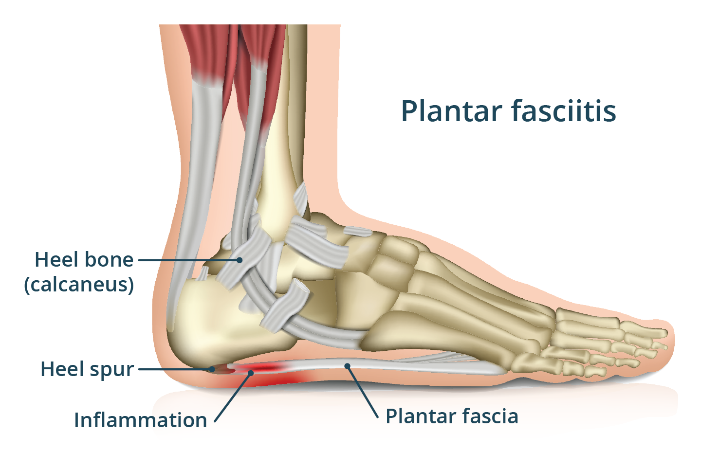 Illustration showing plantar fasciitis.
