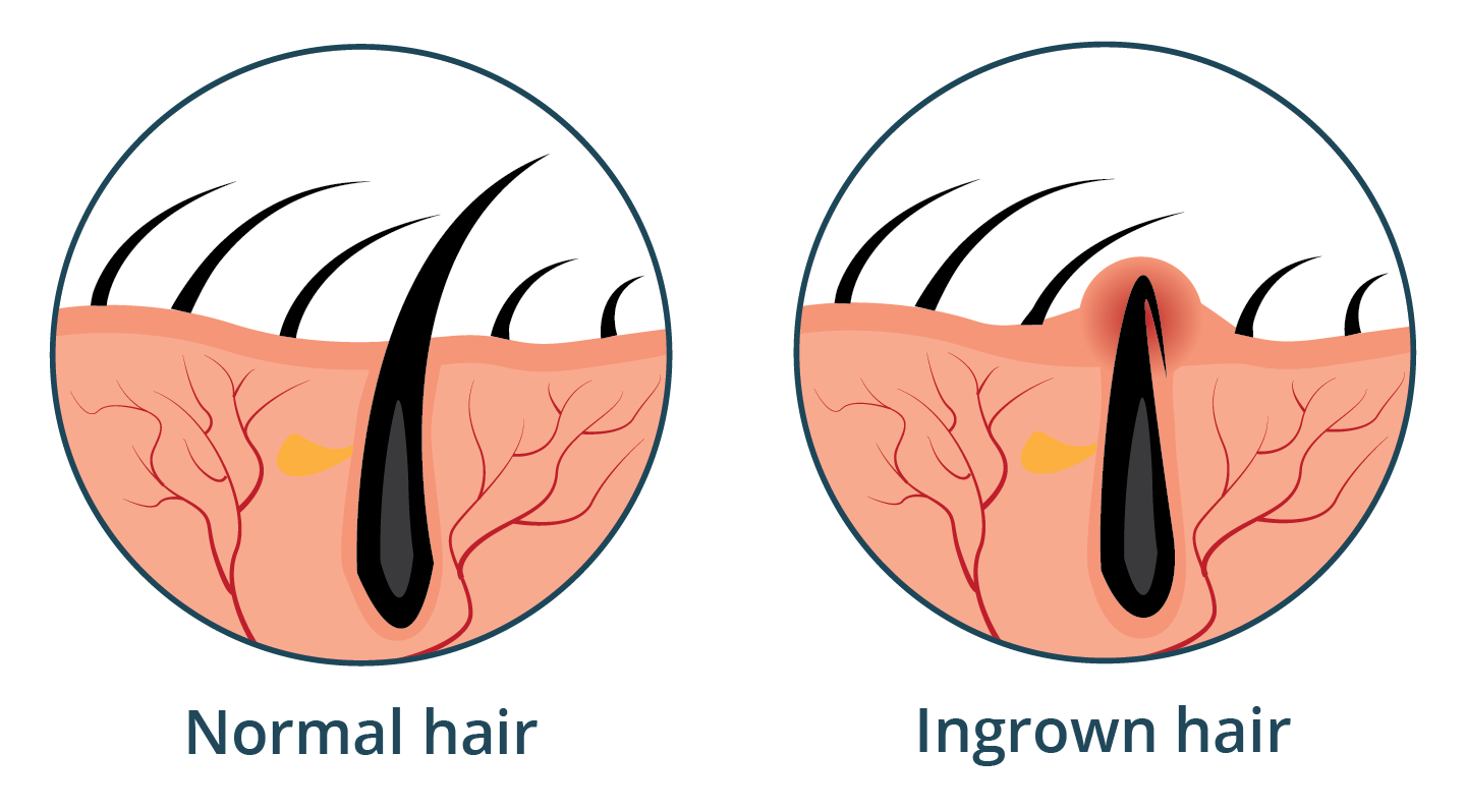 Illustration of an ingrown hair compared to normal hair.