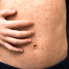 Measles on a stomach