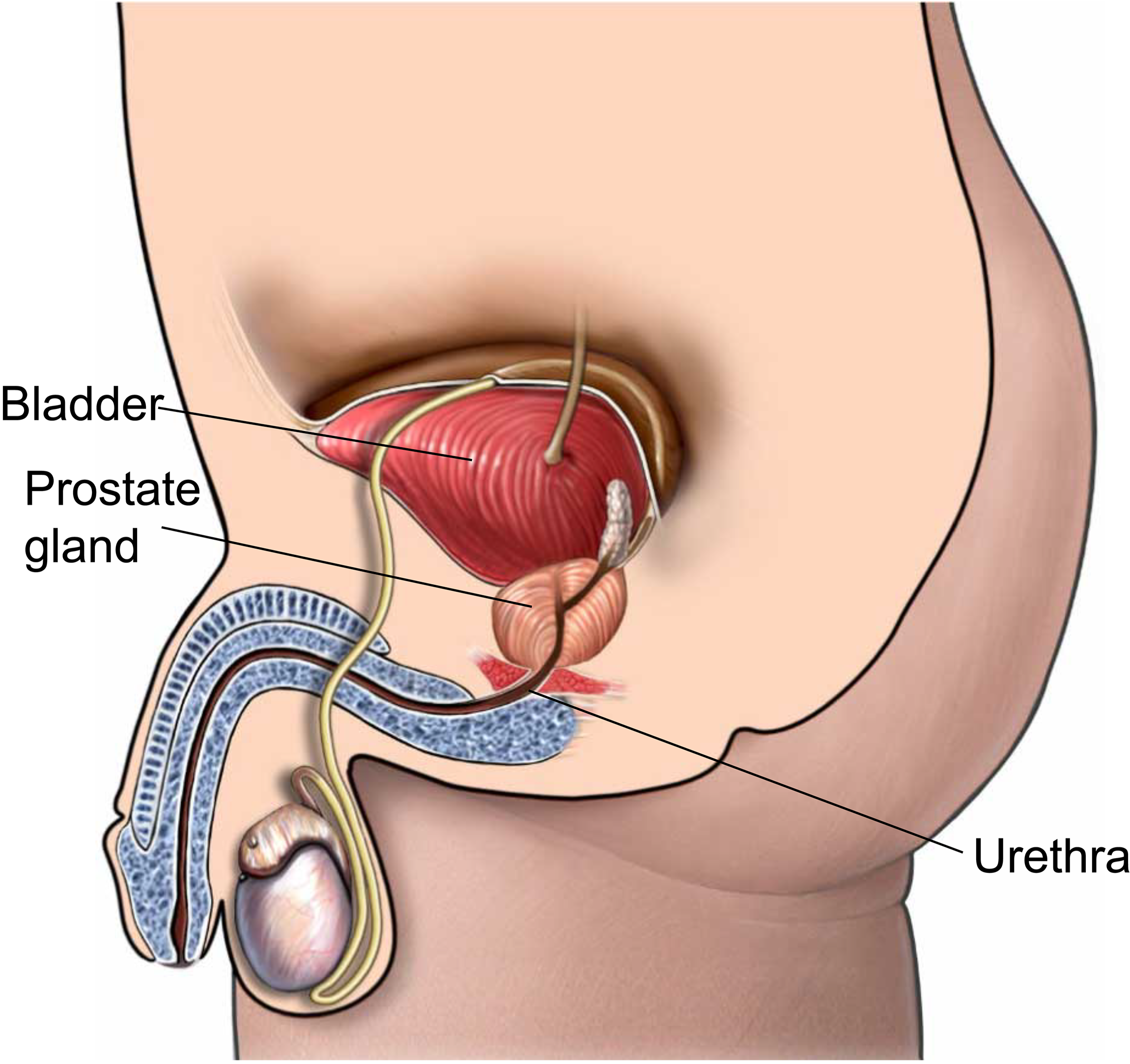 An illustration showing a stone in the ureter.