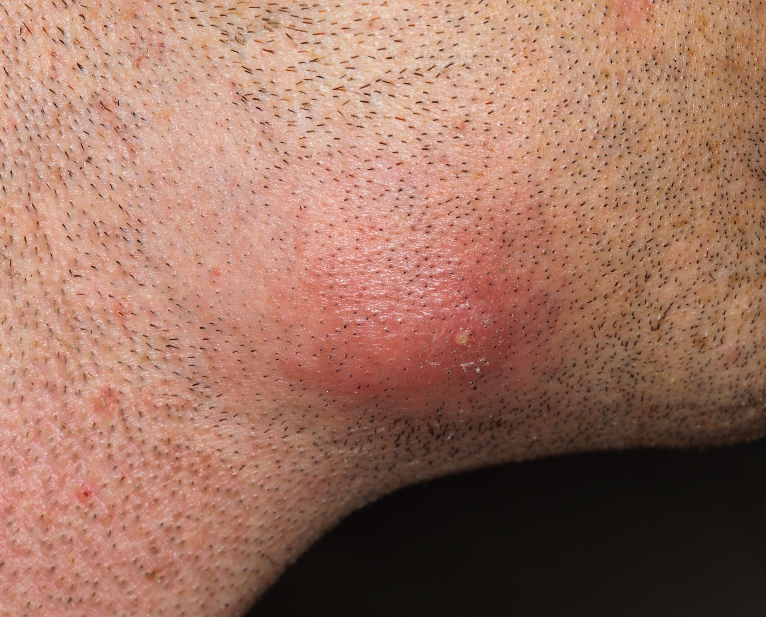 A photo showing a boil thats formed on a persons jawline