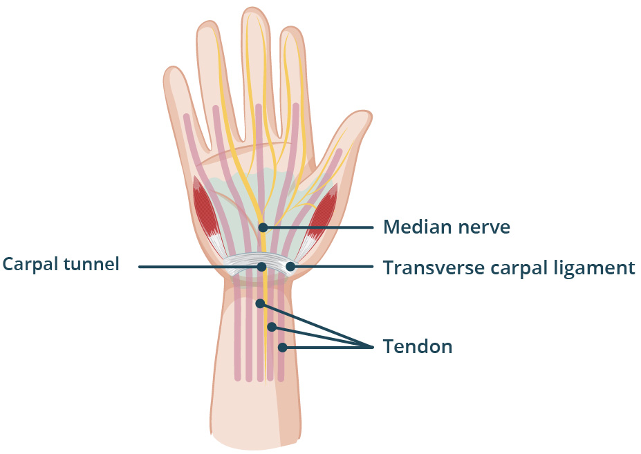 Illustration of a hand (palm-side) and wrist anatomy showing the carpal tunnel, median nerve, ligaments and tendons.
