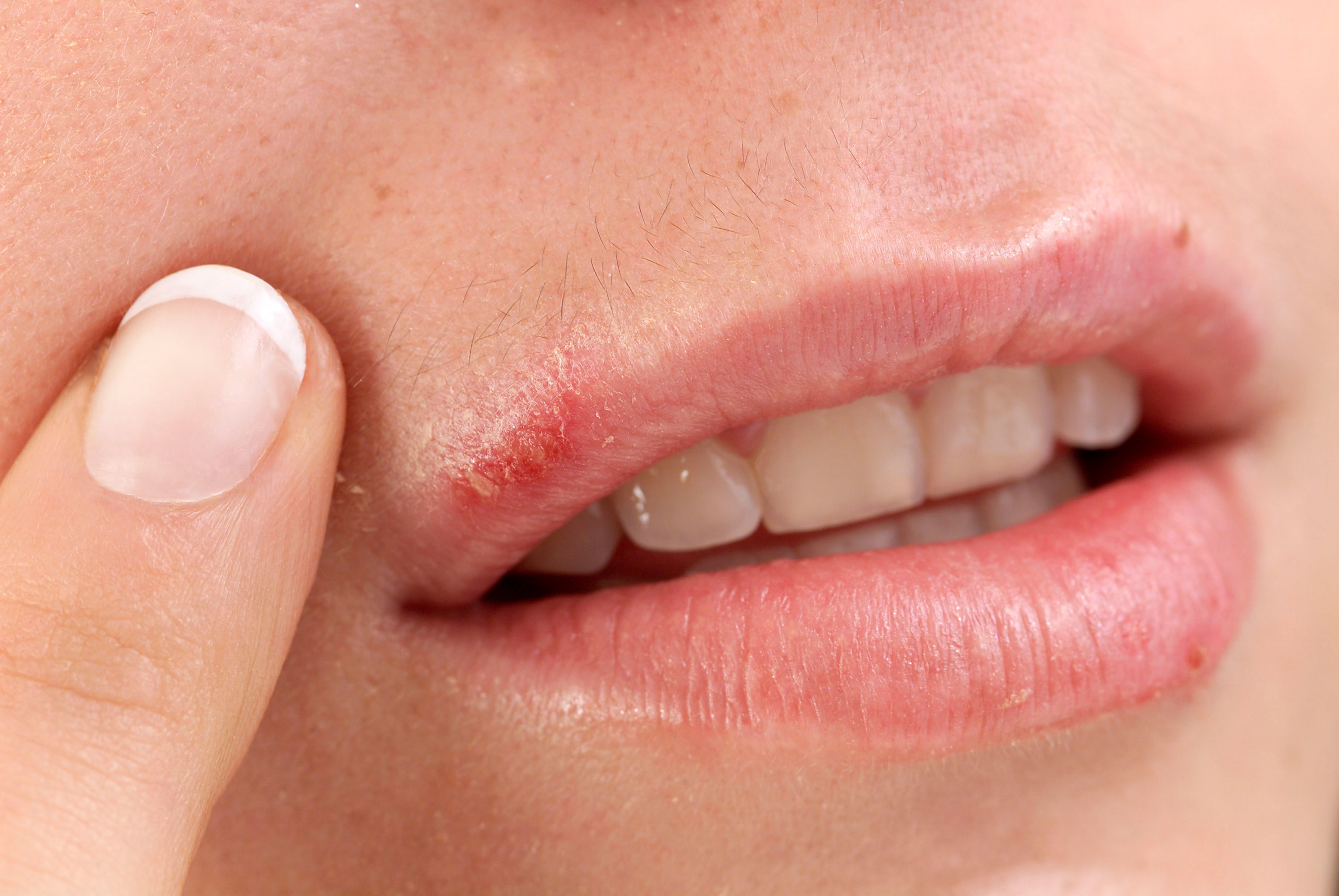 Close up photograph of a mouth with small blister-like coldsores spots on their lips.
