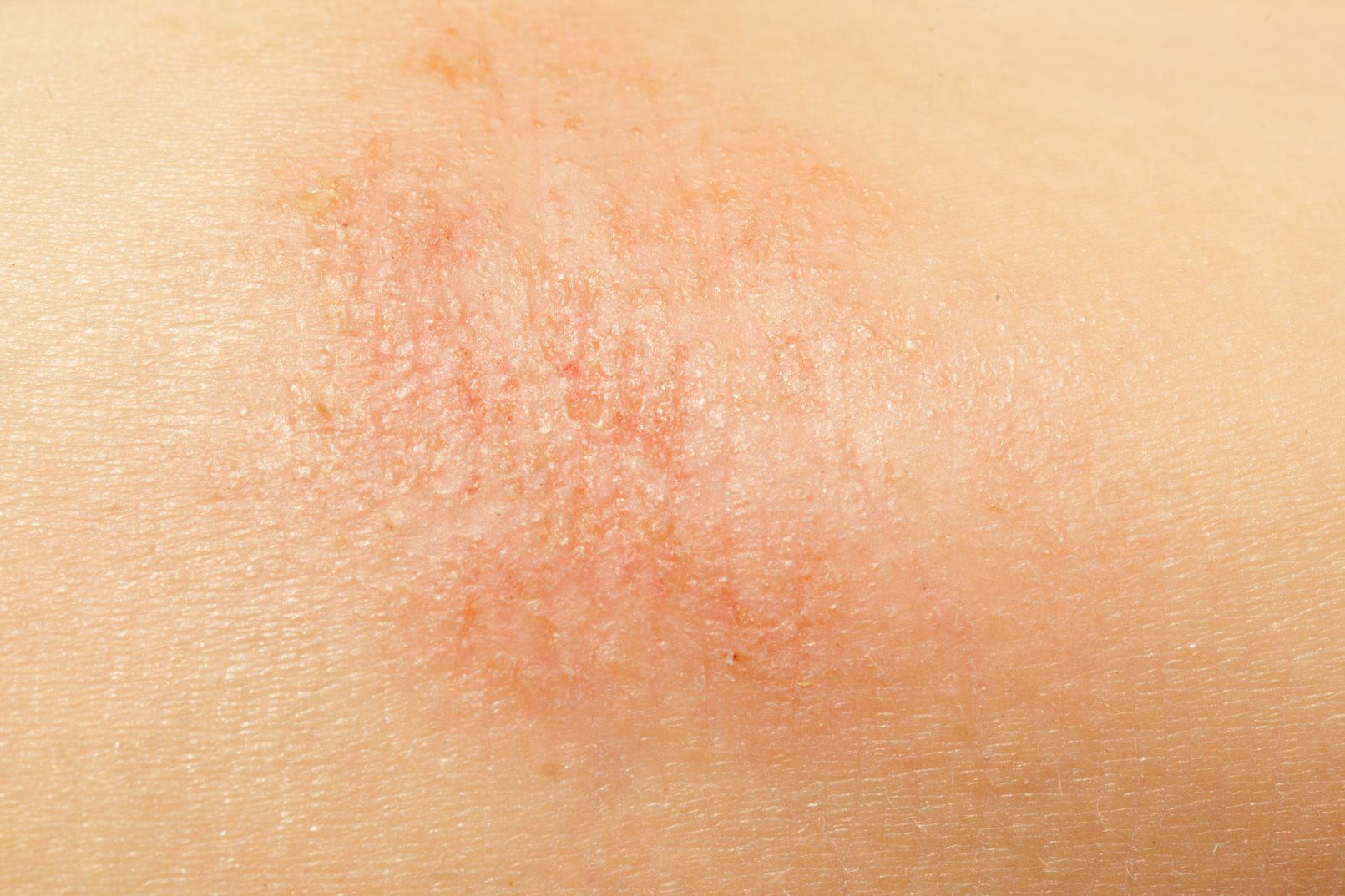 Close up photo of eczema on arm skin.