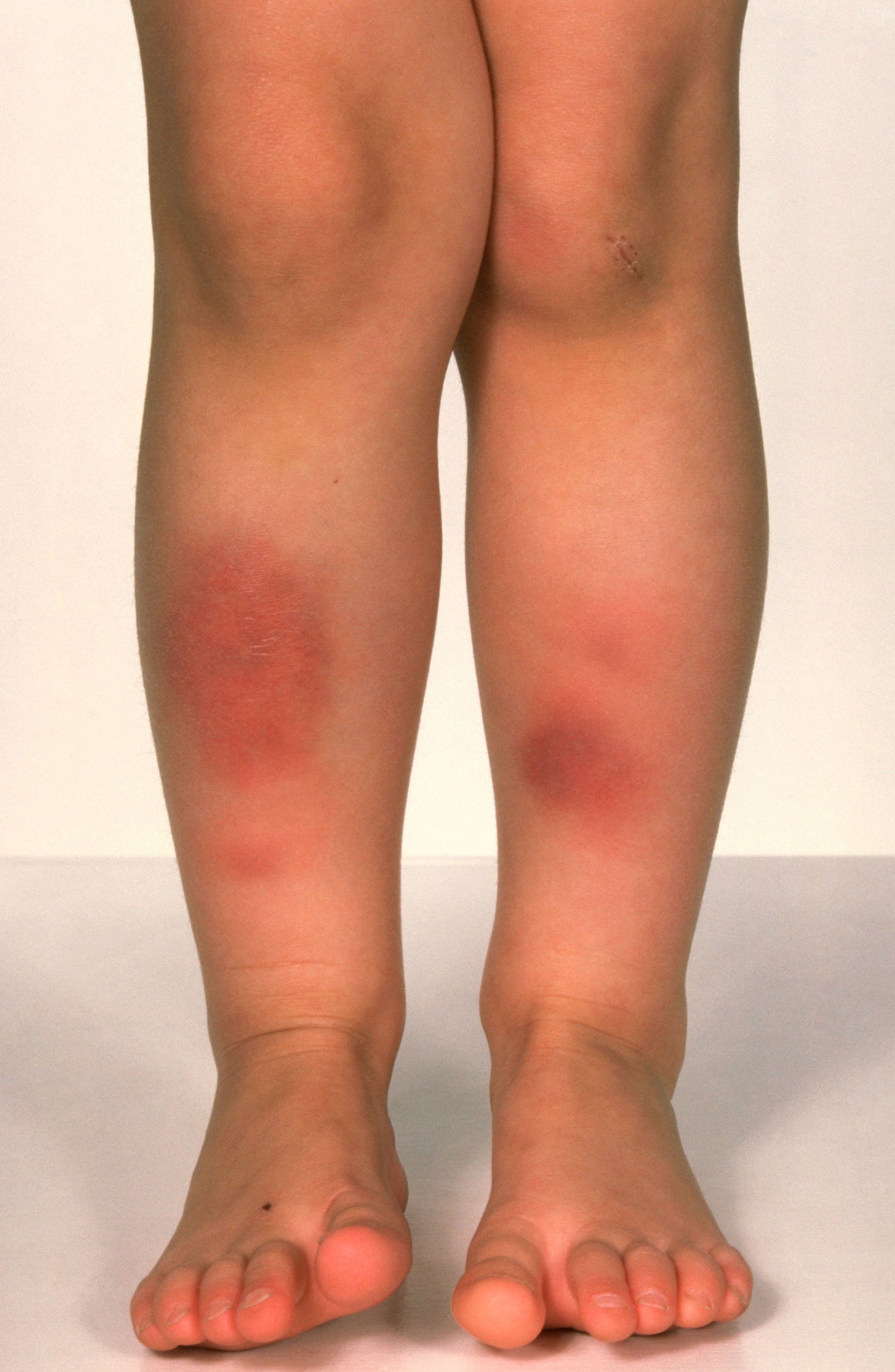 Example of erythema nodosum on the lower legs.