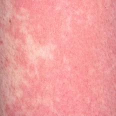 Hives on skin