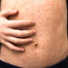 Measles on a stomach
