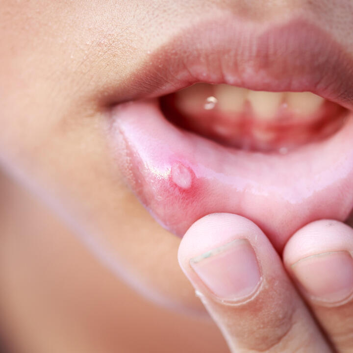 Image of a child pulling down their lower lip to show a sore on the inside of the lip. The sore is round with a white/grey top and a red rim.