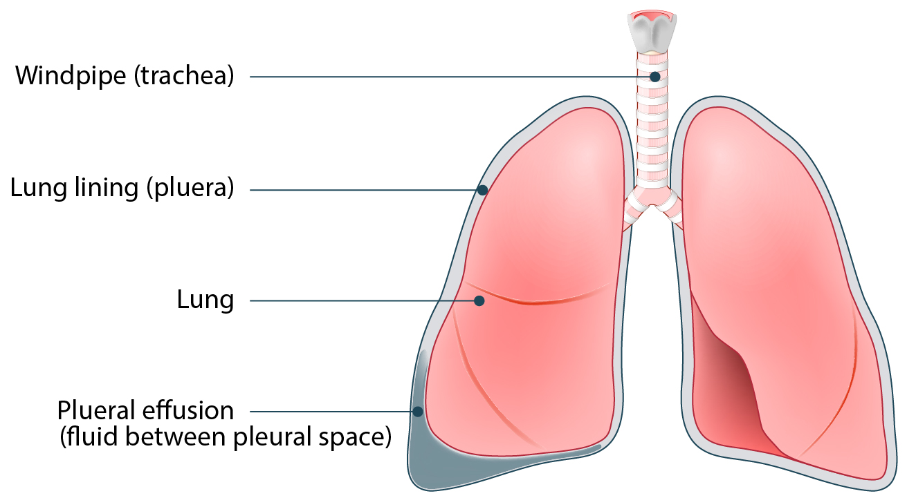 Illustration of human lung anatomy with plueral effusion (build-up of fluid in the pleural space).
