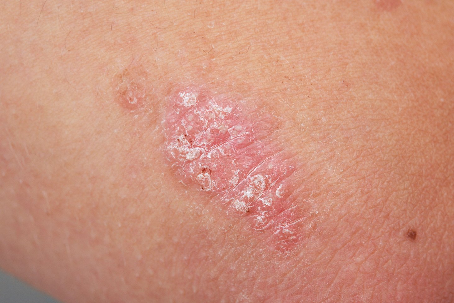 Close-up image of psoriasis on skin.