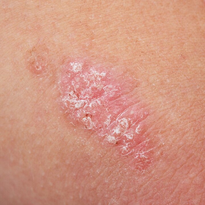 Psoriasis plaques