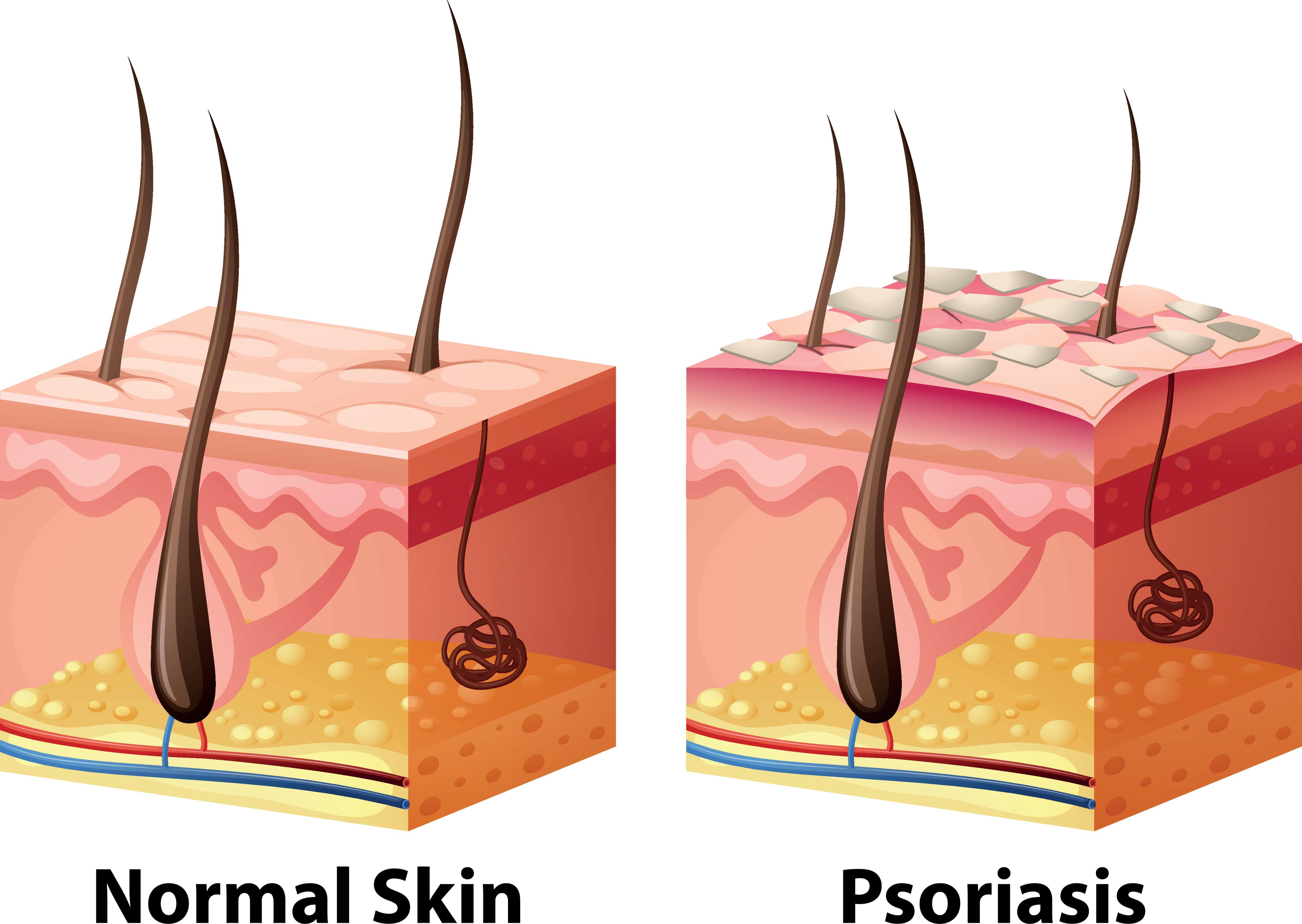 Illustration showing normal skin compared to one with psoriasis.