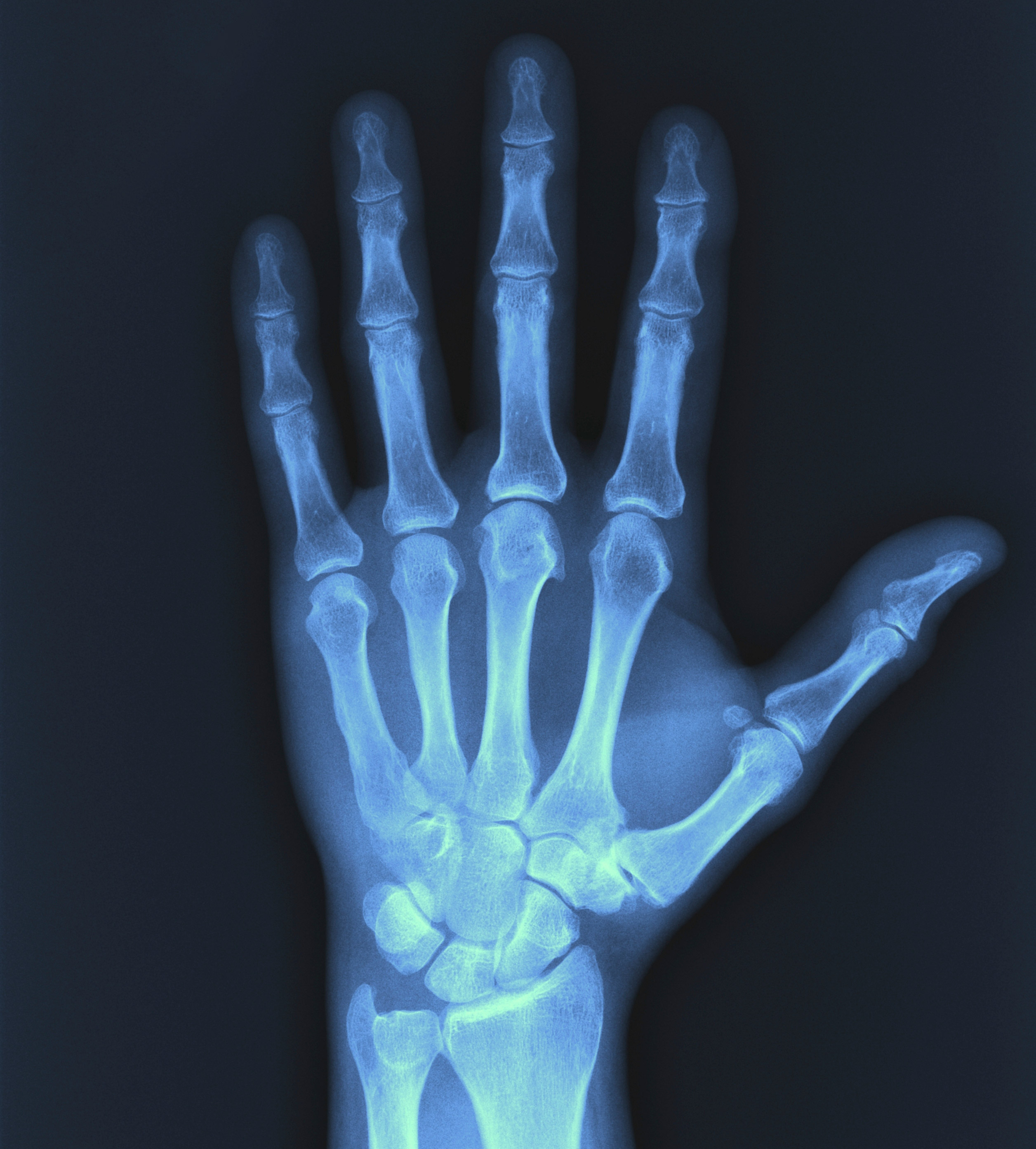 xray of a hand
